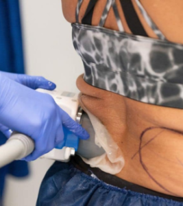 Long Island Coolscuplting